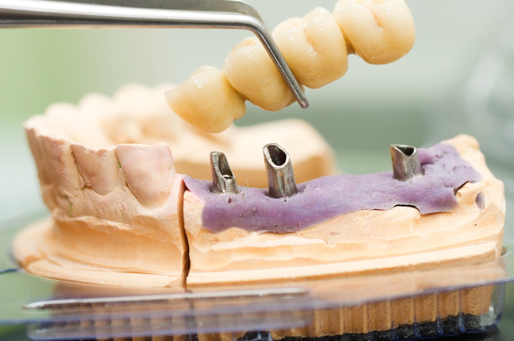 Dentales Modell mit Prothese auf Implantaten von Baraliakos