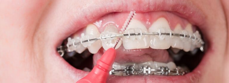 So funktioniert eine professionelle Zahnreinigung bei einer festen Zahnspange